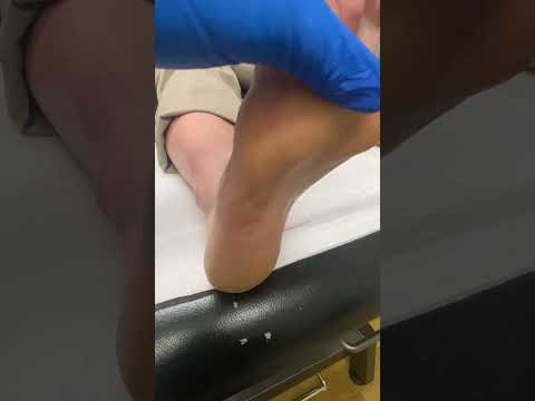 Satisfying Forefoot Callus Removal by Expert Podiatrist #FootCare #Satisfying