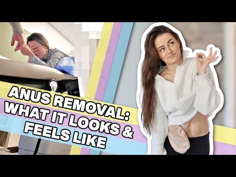 What It Looks & Feels Like to Have Your An*s Removed | Let's Talk IBD