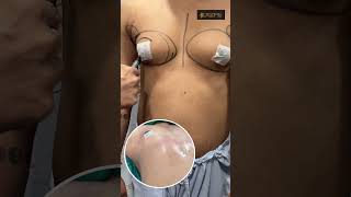 Gynecomastia | Gynecomastia Treatment | Gynecomastia Result