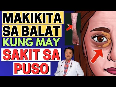 Makikita sa Balat kung May Sakit sa Puso? - By Doc Willie Ong (Internist and Cardiologist)