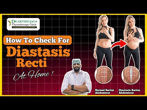 How to Check for Diastasis Recti at Home | Simple Self-Test Guide