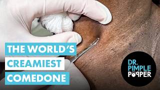 The World’s Creamiest Comedone
