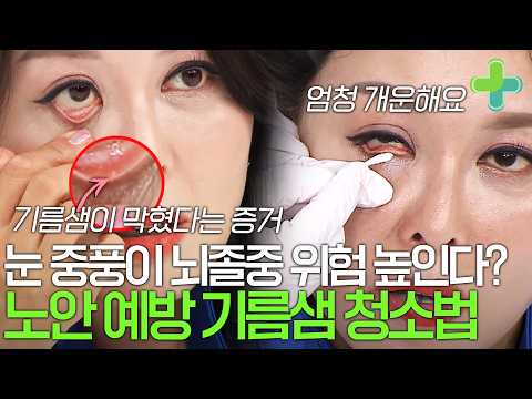 뇌졸중과 <strong>노안</strong> 예방하는 눈 기름샘 청소법