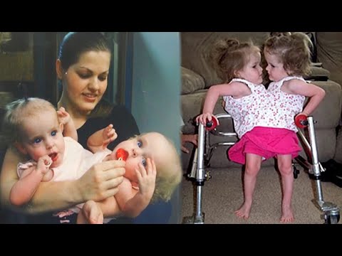 These Siamese twins were separated in 2006. Here's how they live now