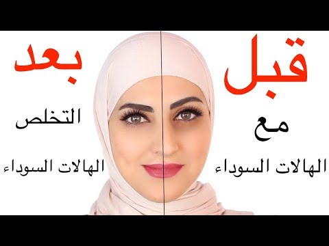 طريقة التخلص من الهالات السوداء سريعا وبشكل طبيعي
