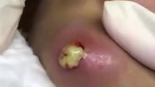 Pimple popping | Cyst popping | Гной | Чистка кожи | Прыщи | Акне | Мерзко |Жесть