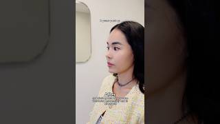 Revising a previous silicone implant rhinoplasty in 2-stages with rib cartilage #asianrhinoplasty
