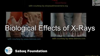 Biological Effects of X-Rays