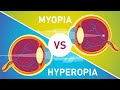 Myopia and Hyperopia Concepts