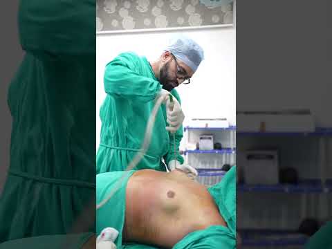 Gynecomastia Surgery cost | #shortvideo #shots | Gynecomastia Surgery #Gynecomastia