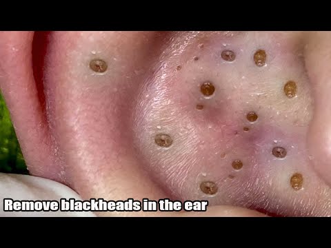 Big Cystic Acne Blackheads Extraction Blackheads & Milia, Whiteheads Removal Pimple Popping # 8704