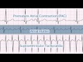 Cardiac Rhythm Management Concepts