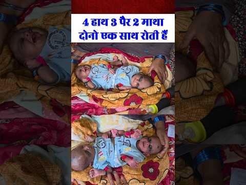 2 सिर के बच्ची जन्म ली | #viralvideo #children #viralreels