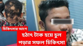 হঠাৎ টাক হয়ে পড়া চুল গজানোর চিকিৎসা। Hairloss solution. Alopecia areata treatment.