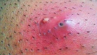 Ingrown Hair Disease Or Medical Condition Videos Kansas City