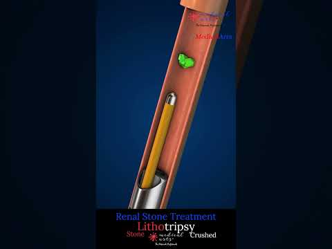How Doctors Remove Kidney Stones Without Surgery! (Lithotripsy demonstrated)