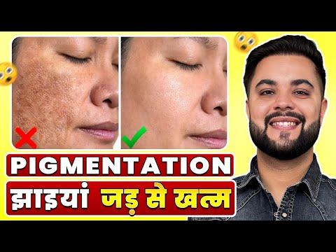 Pigmentation, Dark Spots, झाइयां जड़ से ख़त्म: Best Night Skincare Routine for Clear Skin