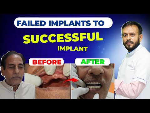 All on 6 Failure Implant Case ! Successfully Done within 5 Days 😊