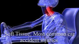 Soft Tissue Injuries in Car Accidents: Understanding Impact of Neck and Back Sprains in Car Crashes