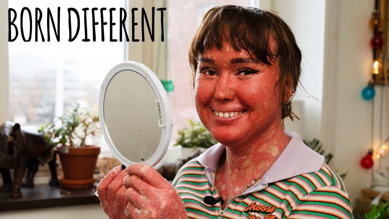 My skin grows too fast - born different