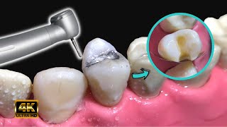 Si tienes esto en tus dientes ¡TEN CUIDADO! - Reemplazo de amalgama por resina compuesta