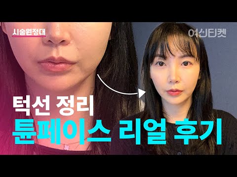 턱선 고민 해결! 튠페이스 시술 리얼 후기 (시술 효과 공개)😻