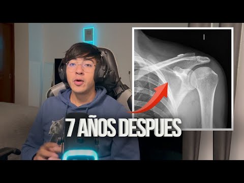 "Vivir con una Luxación Acromioclavicular Grado 3: Mi Experiencia y Consejos"