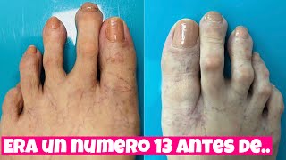 ACORTAMIENTO DE DEDO MINIMAMENTE INVASIVO
