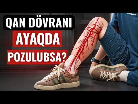 ÇARƏSİ TAPILDI - Ayaqda Varikoz Probleminin Həlli