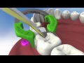 V3 Matrix System Techniques