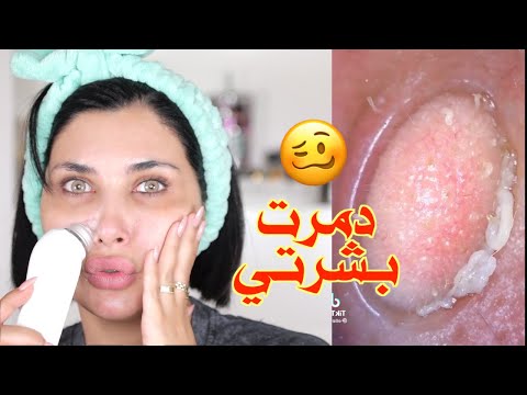انصدمت 😬 بشرتي تحت الميكروسكوب | جهاز شفط الرؤوس السوداء