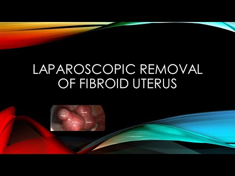 laparoscopic laparoscopy myomectomy