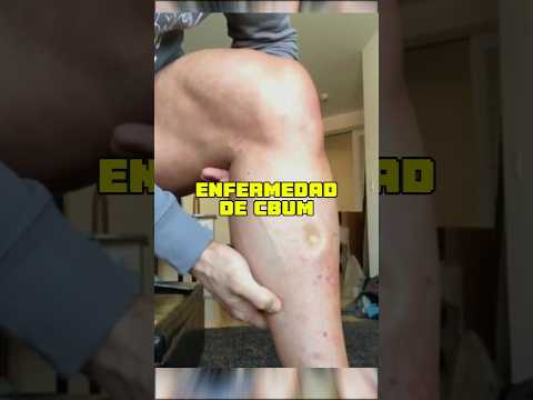 La terrible enfermedad de Cbum 😨•#gym #fitness #culturismo #cbum #gimnasio