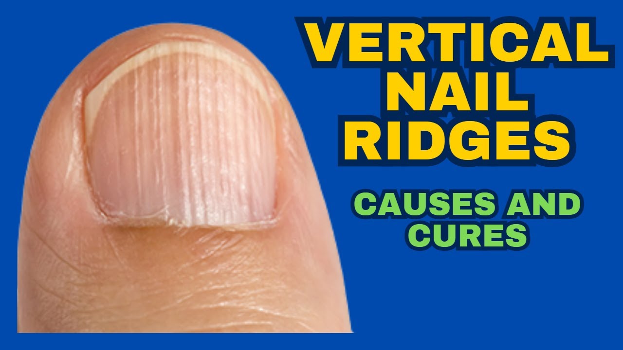 Natural remedies to treat vertical nail ridges