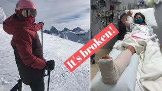 I BROKE MY LEG!... and other things... Chuffed Adventures S4Ep17