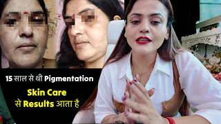 Skincare Routine To Lighten Pigmentation, Acne Marks , Dark Spots | Achieve Glowing Skin