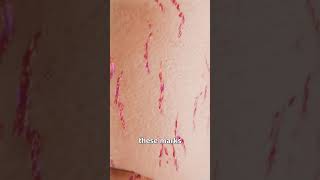 How Stretch Marks Appear 😮