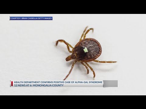 YouTube video thumbnail: Tick-Born Illness That Causes Meat Allergy Confirmed in West Virginia