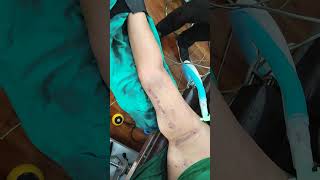 Arm Liposuction result | Underarm liposuction #shorts