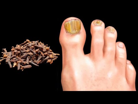 Entfernt Nagelpilz sofort, wie ein Radiergummi! Das beste Mittel! Wirksam gegen Nagelpilz 💯%