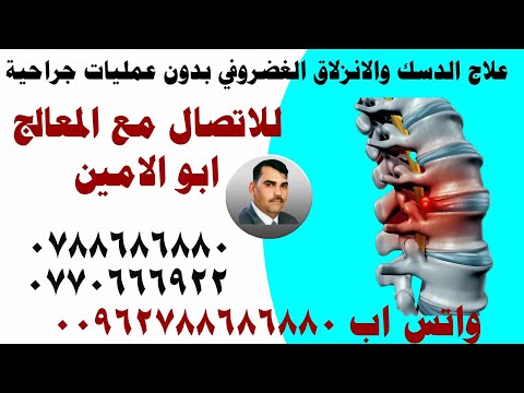 هل من الممكن ان يتسبب العطاس في ديسك الرقبة