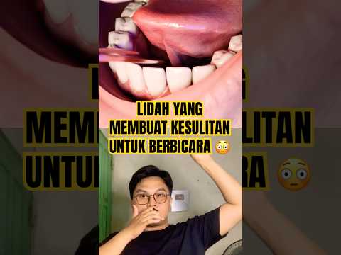 Lidah yg membuat sulit berbicara😳 #dentist #orthodontist #invisalign #thebaldheadnthedreadpodcast