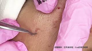 20250509黑頭粉刺Blackheads--Taiwan Yilan City-宜蘭清粉刺達人-亞芳美妍館-Eva莊雅芳老師