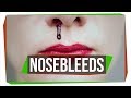 Understanding Nosebleeds