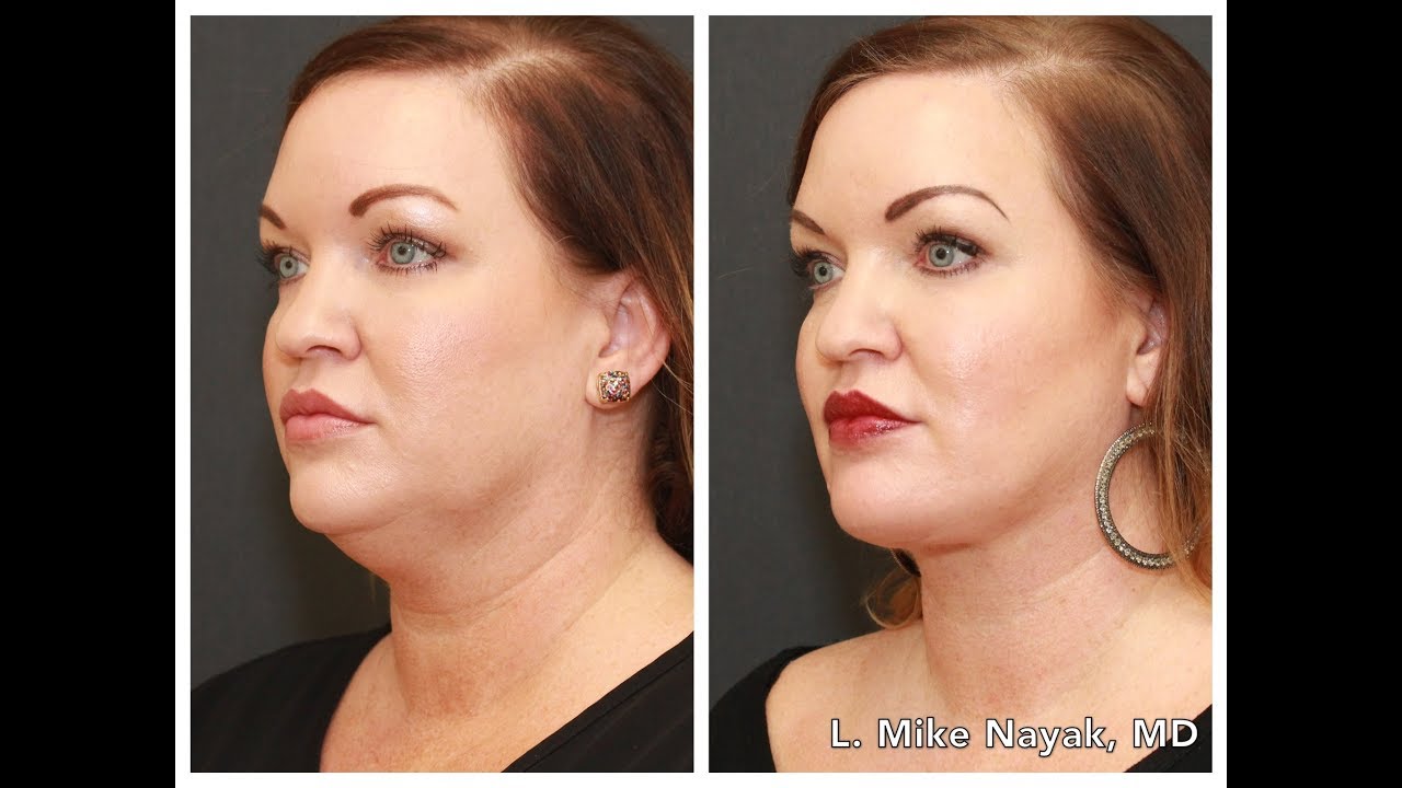 Before and after facial contouring results.