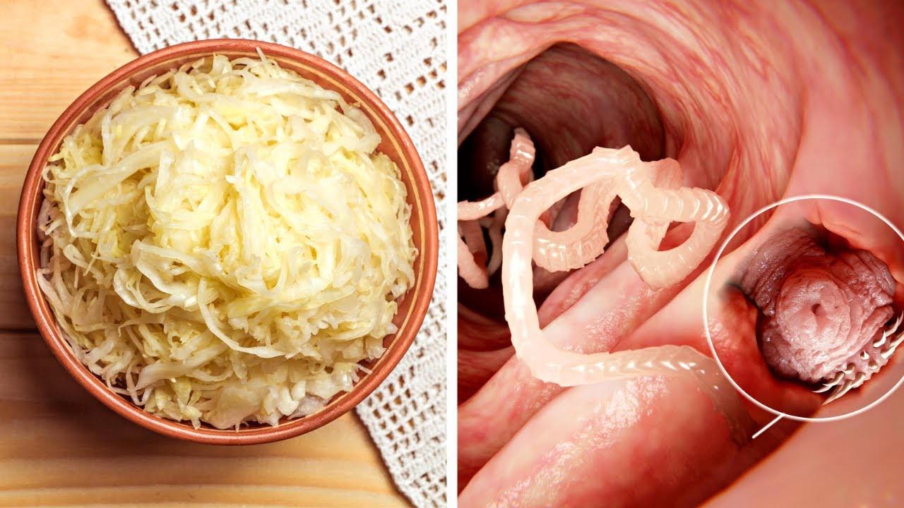 Eat These Foods To Sweep Parasites Out of Your Intestines￼