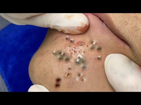 Relax Everyday with Blackheads & Acne Treatment 227