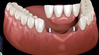 DENTAL IMPLANT vs DENTAL BRIDGE