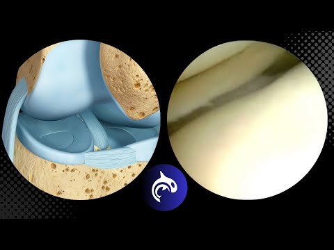 Watch a Knee Surgeon fix a Torn / Locked Meniscus #knee #kneepain #kneepainrelief