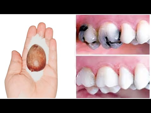 الحل الرهيب لعلاج تسوس الاسنان الذى يخفيه الأطباء ،لن تلجأ لإقتلاع الأضراس،ستعود كما كانت بدون تسوس